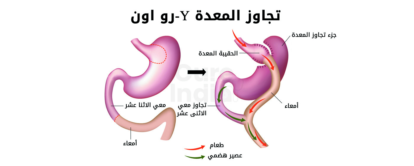 تبديل معده الاثني عشر